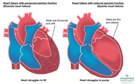 Ru58841 Heart Failure. . Ru58841 heart failure